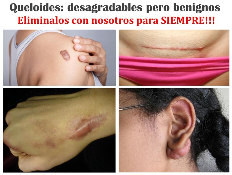 Fotografía 2 de Procedimiento retiro de QUELOIDES, en todo el cuerpo. (previa evaluación).  Â¡PAGAR MENOS ESTA EN T en SANTIAGO, Metropolitana