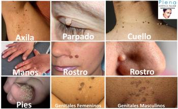 Procedimiento retiro de QUELOIDES, en todo el cuerpo. (previa evaluación). ¡PAGAR MENOS ESTA EN T